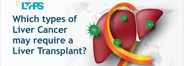 Liver Transplant International